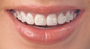 Brackets Radiance Plus Individuales